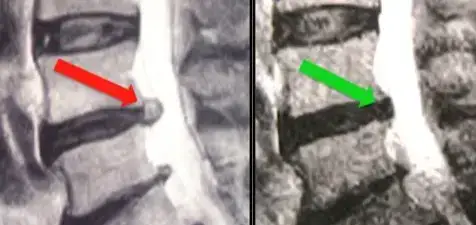 L5 S2 column injurie of a runner